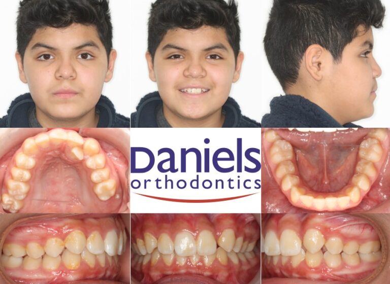 before pictures of patient's teeth